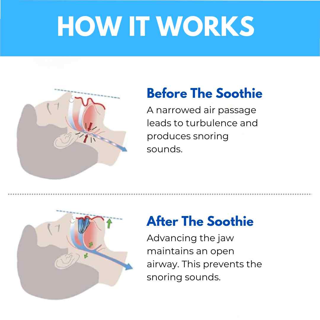 THE SOOTHIE ANTI SNORING MOUTHPIECE